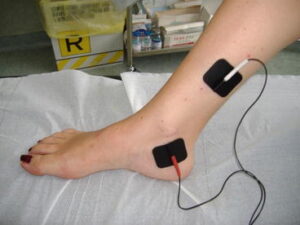 Electroestimulación y neuromodulación